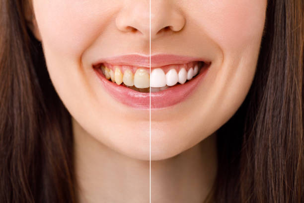 Teeth whitening treatment